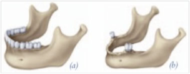 Dentla Implants Ilustration
