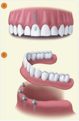 Dental Implants Illustration